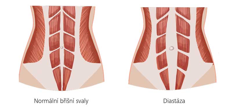Normální břišní svaly a diastáza břišních svalů