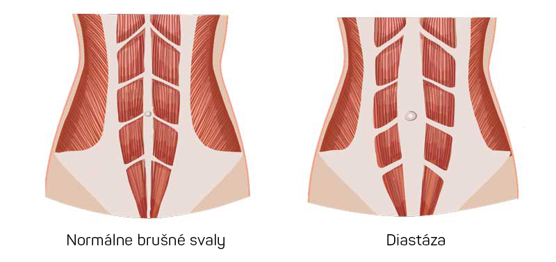 Normální břišní svaly a diastáza břišních svalů