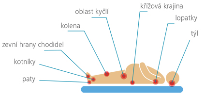 Kde dekubity nejčastěji vznikají