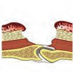 IV. stupeň